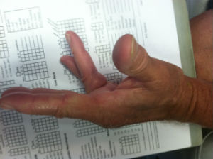 Copy of dupuytren finger