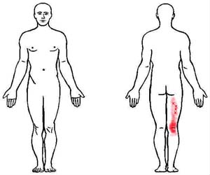 biceps femoris trigger point