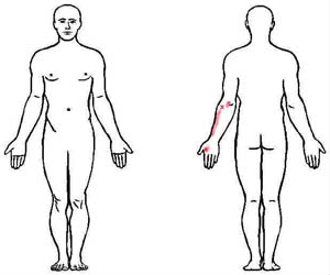 brachioradialis trigger point