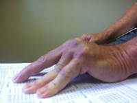 dupuytren finger