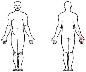 extensor carpi radialis brevis trigger point