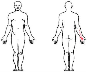 extensor carpi radialis longus trigger point