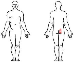 gluteus medius trigger point