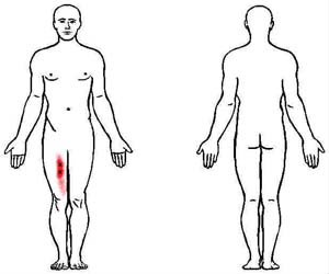gracilis trigger point