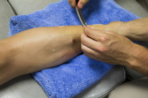 Graston Technique Bruise