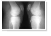 osgood schlatter2