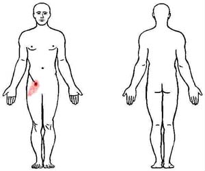 pectineus trigger point