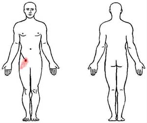 Pectineo-femoral pinch syndrome: A common cause of groin & anterior thigh  pain and weakness - MSK Neurology