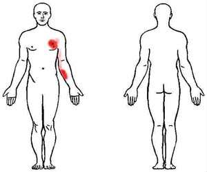 pectoralis major trigger point