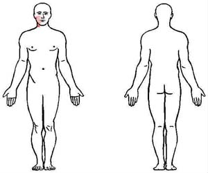platysma trigger point