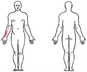 pronator teres trigger point