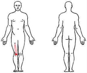 rectus femoris trigger point