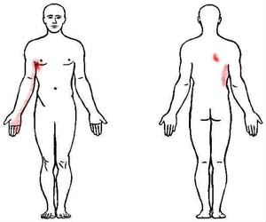serratus anterior trigger point