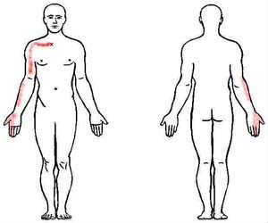 subclavius trigger point