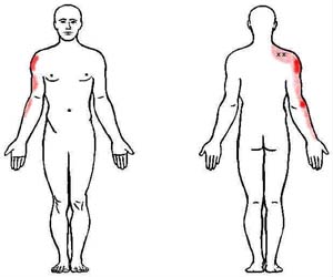 supraspinatus trigger point