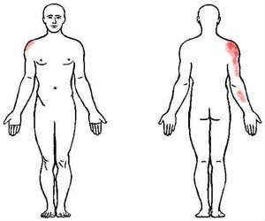 teres major trigger point