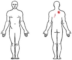 trapezius trigger point