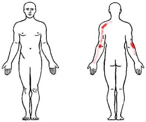 triceps brachii trigger point